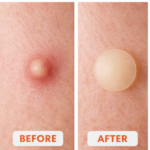 Hydrocolloid Acne Spot Patches – Fast-Acting Invisible Blemish Treatment for Clearer Skin - Image 4